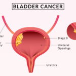 Bladder Cancer