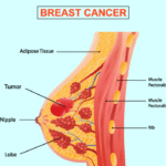 Understanding Breast Cancer and Its Impact 2 image 2023 05 08T06 09 08 039Z